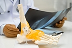 How Is Ankle Arthritis in Charleston, SC, Diagnosed and Treated?