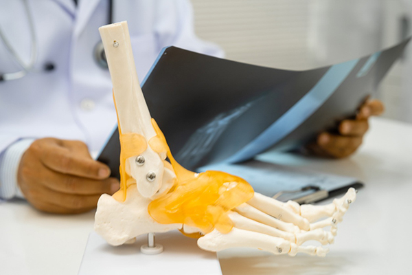 How Is Ankle Arthritis in Charleston, SC, Diagnosed and Treated?