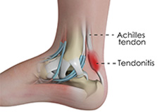 Achilles Tendinitis