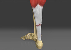 Achilles Tendon Rupture