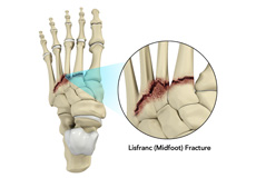 Lisfranc (Midfoot) Fracture