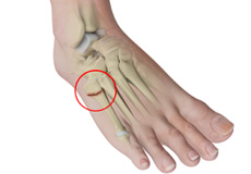 Fifth Metatarsal Fractures