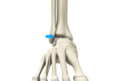 Osteochondral Injuries of the Ankle