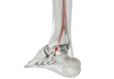 Posterior Tibial Tendon Dysfunction