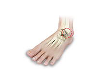 Foot Rheumatoid Arthritis