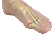 Stiff Big Toe (Hallux Rigidus)