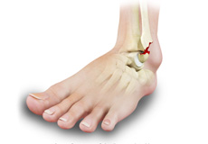 Stress Fractures of Foot and Ankle