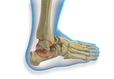 Talus Fracture