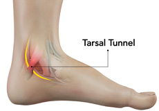 Tarsal Tunnel Syndrome